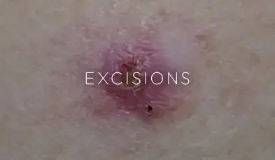 A close-up clinical photo of a skin lesion prior to excision, captioned "Excisions."