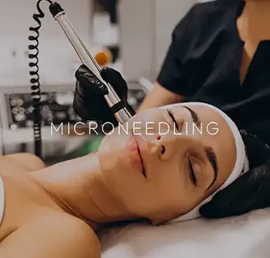 A clinician performing a microneedling treatment on a patient’s face, captioned "Microneedling."