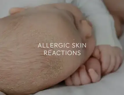 An infant’s head with a skin reaction on the scalp, captioned "Allergic Skin Reactions."