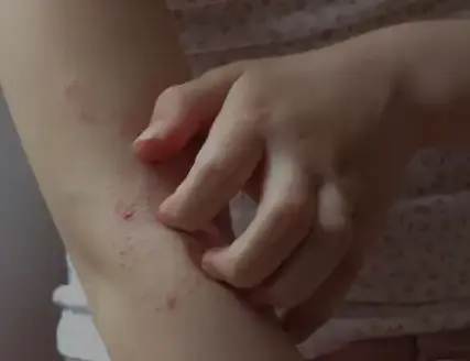 A child scratching an eczema rash on the inside of the arm.