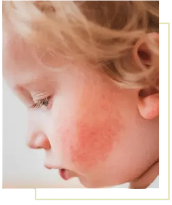A close profile of a fair-haired toddler with a red, inflamed eczema rash across the cheek.