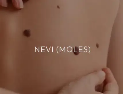 Moles on a child’s back, captioned "Nevi (Moles)."